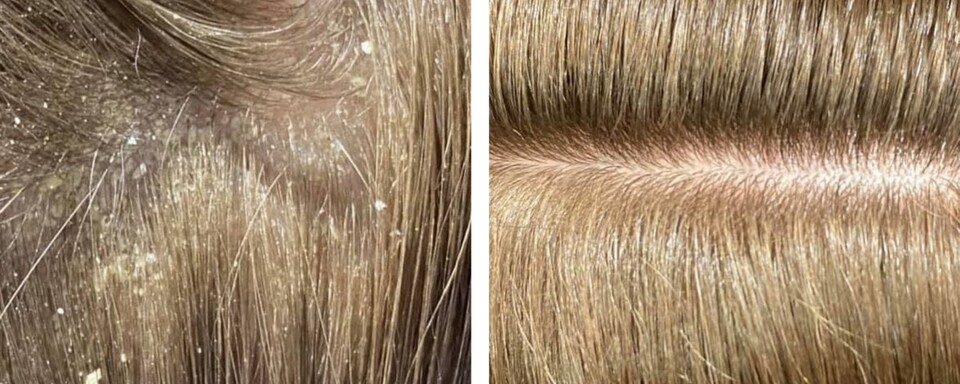 Ravitulemus enne ja pärast